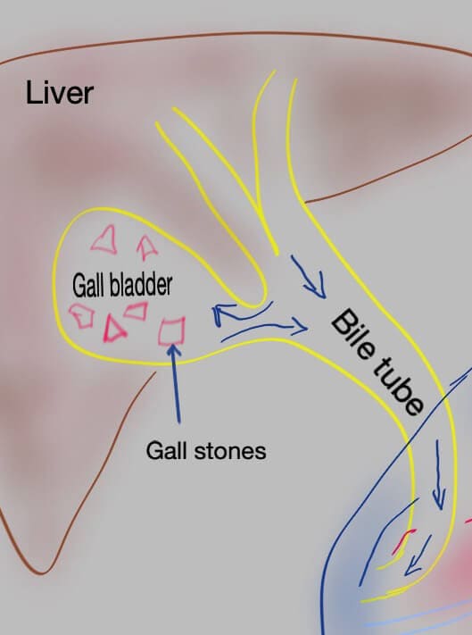 Gallstones in the gallbladder