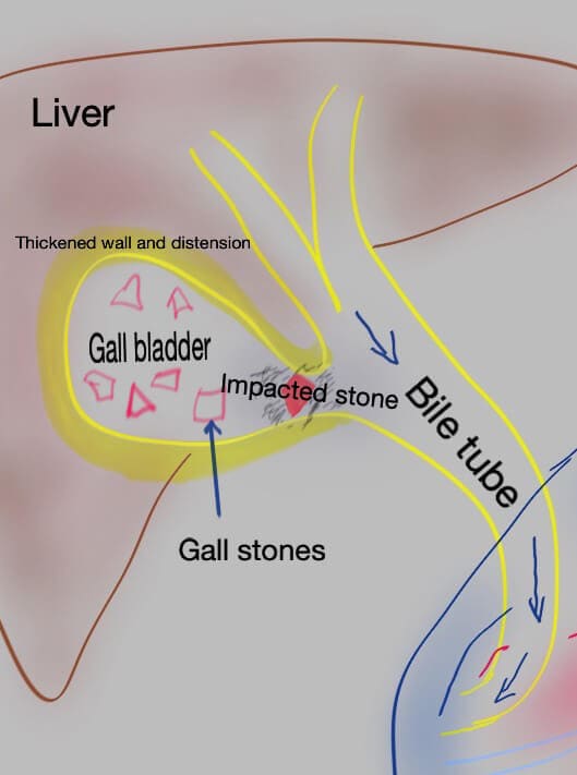 Impacted gallstone