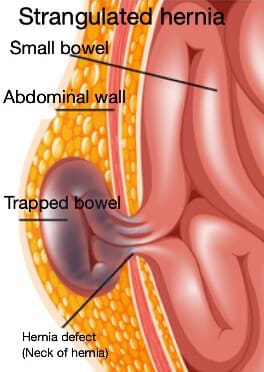 Strangulated hernia